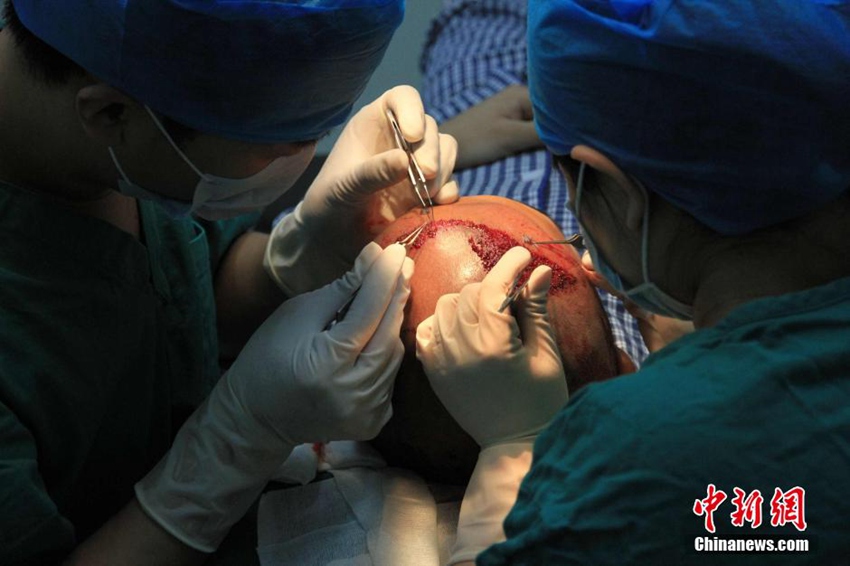 高清:北京一植发医院网上视频直播植发过程