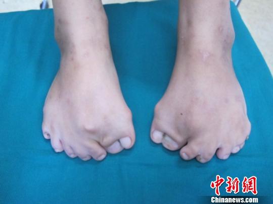 重庆8岁女孩患罕见口面指综合症 双脚长15根脚